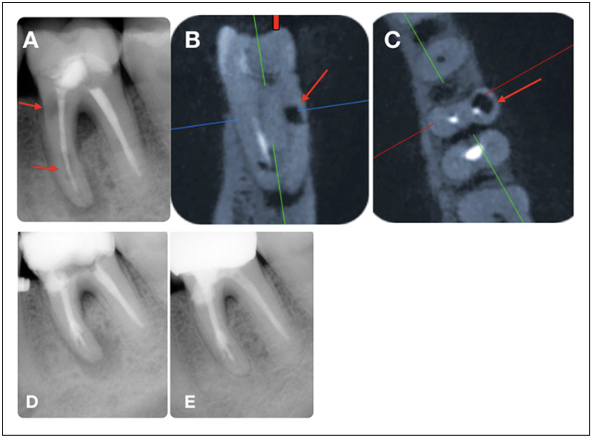  Figura 1. A): radiografía inicial en la que se observa zonas radiolúcidas a nivel de tercio medio y cervical de la raíz mesial (flechas rojas), compatibles con reabsorción interna, radiolucides circunscrita en apical de la raíz mesial, y pérdida ósea a nivel de furca; B) y C): cortes sagital y coronal de TCHC de la raíz mesial en el que se observa reabsorción interna a nivel cervical; D): radiografía final del tratamiento; E): radiografía control de 2 años en la que se observa curación apical y disminución significativa de la pérdida ósea a nivel de furca en comparación a la radiografía inicial.