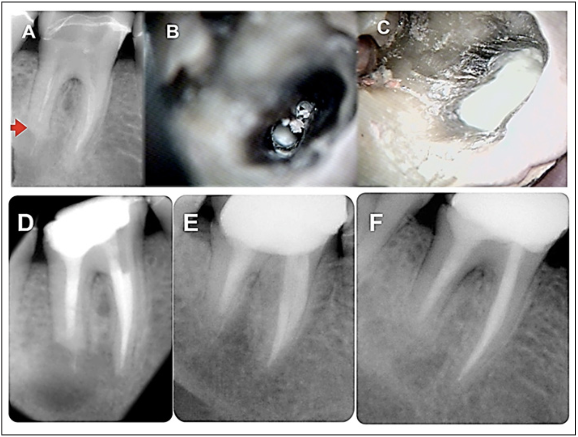 Figura 2. A): radiografía inicial en la que se observa molar inferior con tratamiento de conducto deficiente, presencia de reabsorción apical externa en la raíz distal (flecha roja), lesión apical de gran tamaño y material de obturación compatible con gutapercha en los tejidos periapicales; B): imagen clínica con magnificación de 10X de conducto distal con hidróxido de calcio; C): imagen clínica con magnificación 10X del conducto distal con obturación de MTA; D): radiografía final en la que se observa un preparo más amplio y mejor calidad de la obturación de los conductos; E): radiografía control de 1 año en la que se observa el molar restaurado con una corona metal porcelana, aunque por distal de la corona se aprecia un desajuste de esta y se evidencia en la raíz distal curación de la patología periapical; F): radiografía control de 5 años en la que se observa características radiográficas de normalidad y curación total a nivel apical de las raíces distal y mesial.