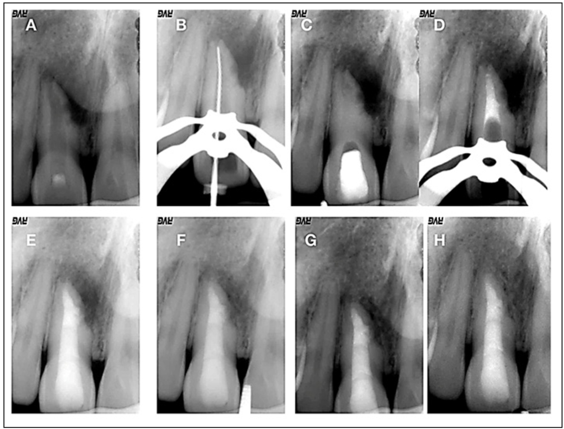 Figura 3. A): radiografía inicial en la que se observa patología periapical y reabsorción externa muy evidente en mesial de un incisivo superior el cual fue dejado abierto; B): radiografía de conductometría; C): radiografía en la que se observa radiopacidad del hidróxido de calcio; D: radiografía en la que se observa el relleno con MTA; E): radiografía final de la obturación del conducto; F): radiografía control 1 año; G): radiografía control 2 años; H): radiografía control 7 años.