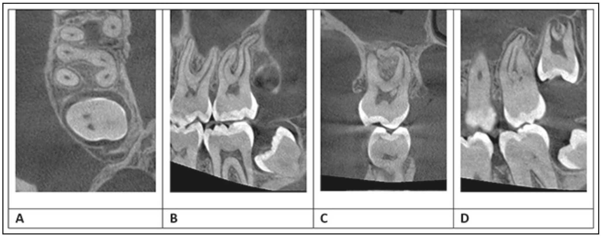 Figura 2. Tomografía de campo reducido diente 1.7 A): Vista axial tercio apical: presencia de 4 canales radiculares B): vista sagital canal mesio y distovestibular C): vista coronal canal distopalatino D): vista sagital canal mesiopalatino