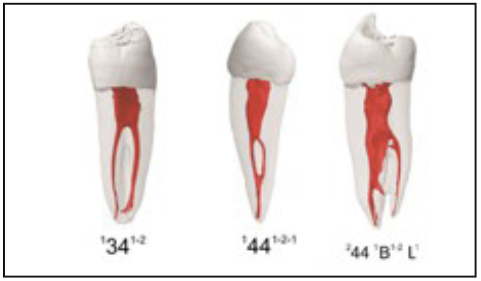 Figura 3. Esquema gráfico de la clasificación de Ahmed 3.4/4.4: diente. Superíndice izquierdo: número de raíces. Super índice derecho: número de canales. B: raíz bucal. L: raíz lingual