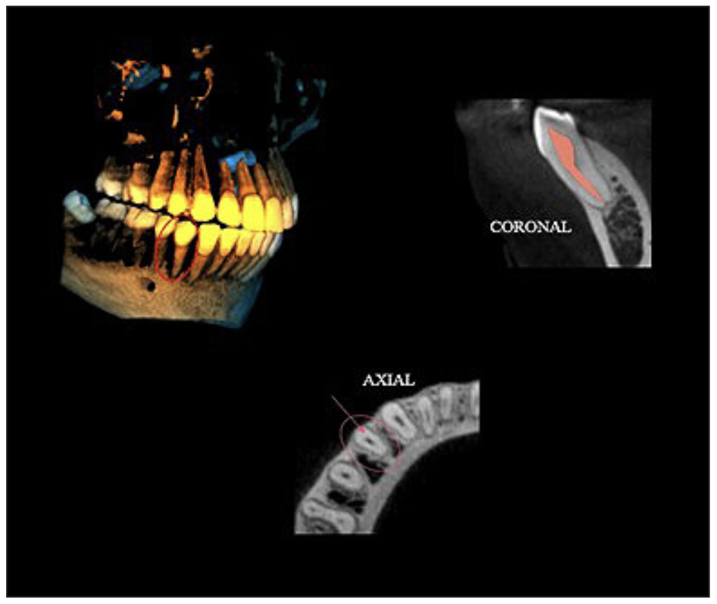 Figura 4. Vista externa de el diente 3.4 (3D), vista coronal y axial correspondiente a la clasificación 1PM (1) según Ahmed.