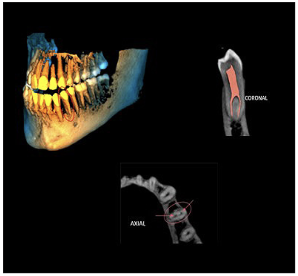 Figura 5. Vista externa de el diente 3.4 (3D) donde se puede observar la presencia de un surco radicular, vista coronal y axial correspondiente a la clasificación 1PM (1-2) según Ahmed.