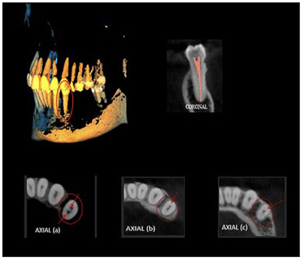 Figura 6. Vista externa de el diente 3.4 (3D) donde se puede observar la presencia de un surco radicular, vista coronal y axial correspondiente a la clasificación 1PM (1-2) según Ahmed.